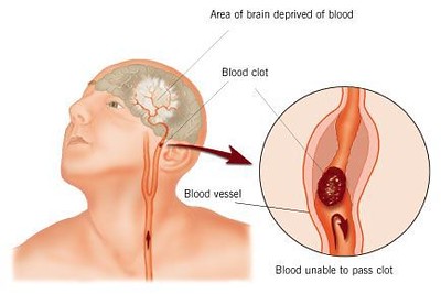 뇌경색 전조증상