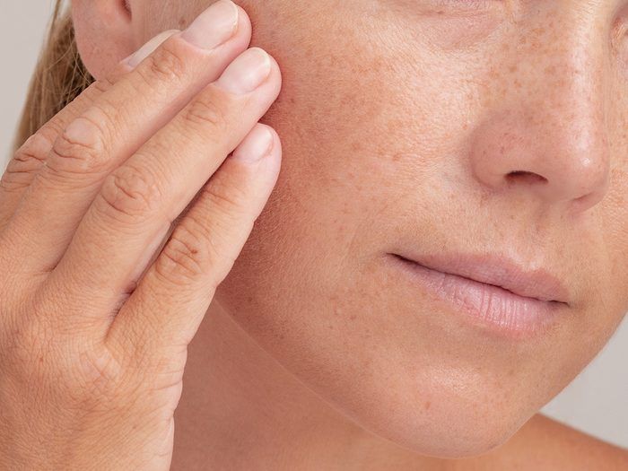 기미와다크써클의차이&amp;quot;/