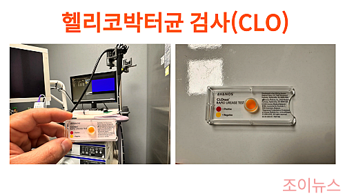 CLO(신속 요소분해효소검사: 위내시경)검사 방법