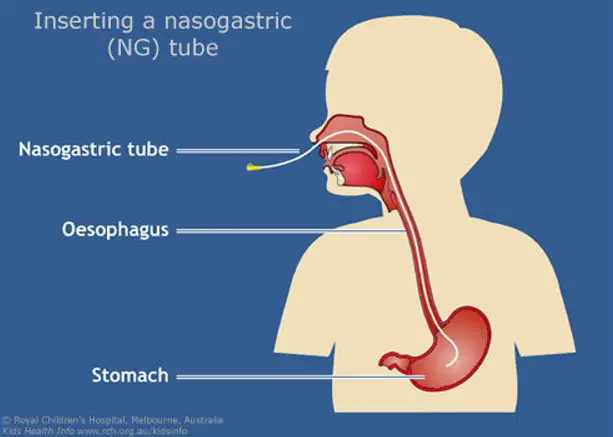 비위관-삽입-이해 위한-그림