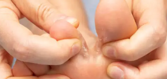 무좀 증상, 치료, 재발방지 총 정리 (2025 최신)