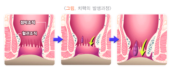 치핵의 발생과정