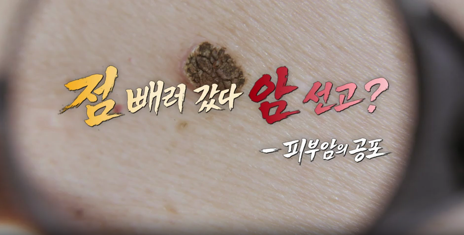 명의 피부암 점 구별법