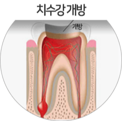 충치 신경치료 디테일한 과정
