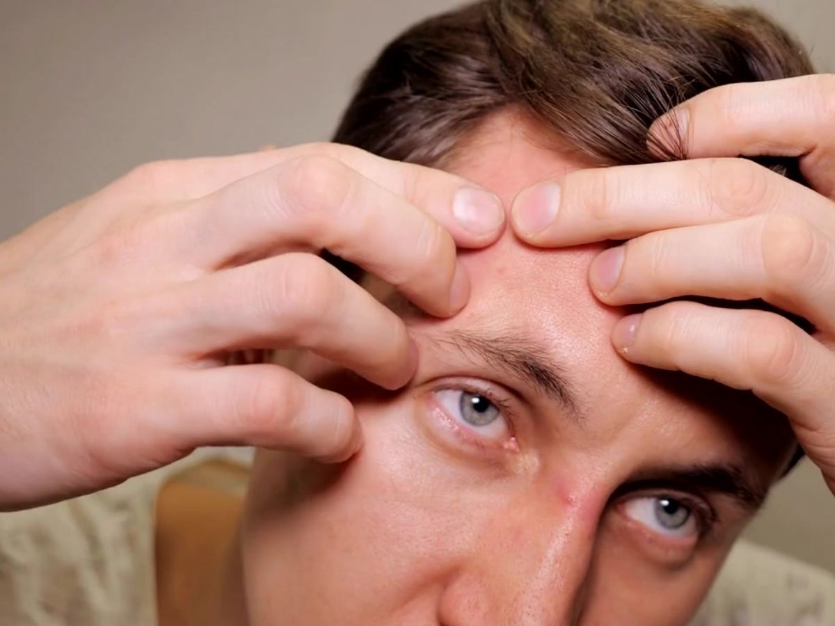 좁쌀여드름 압출