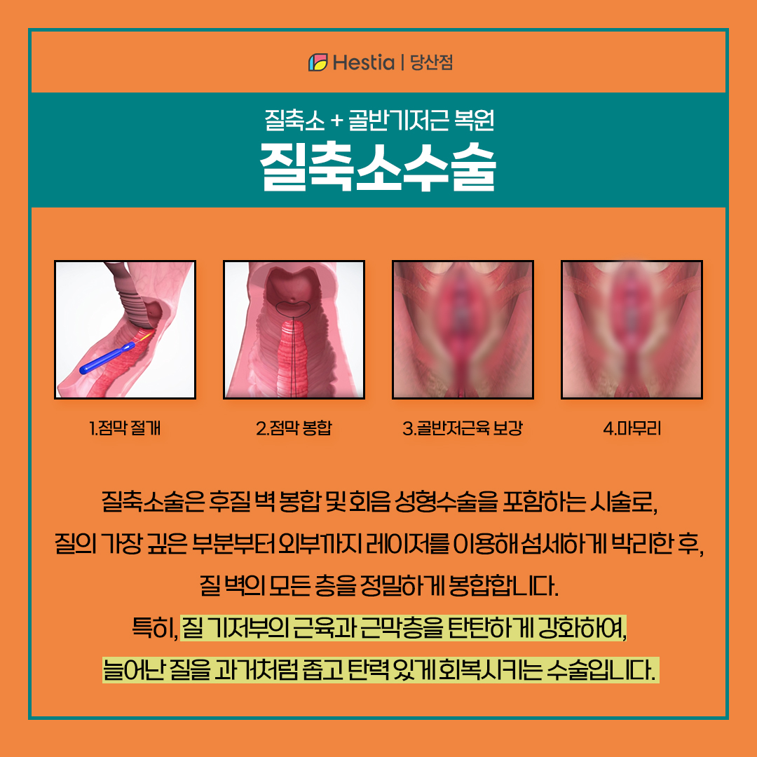 질축소수술에 대해 알아봅시다!