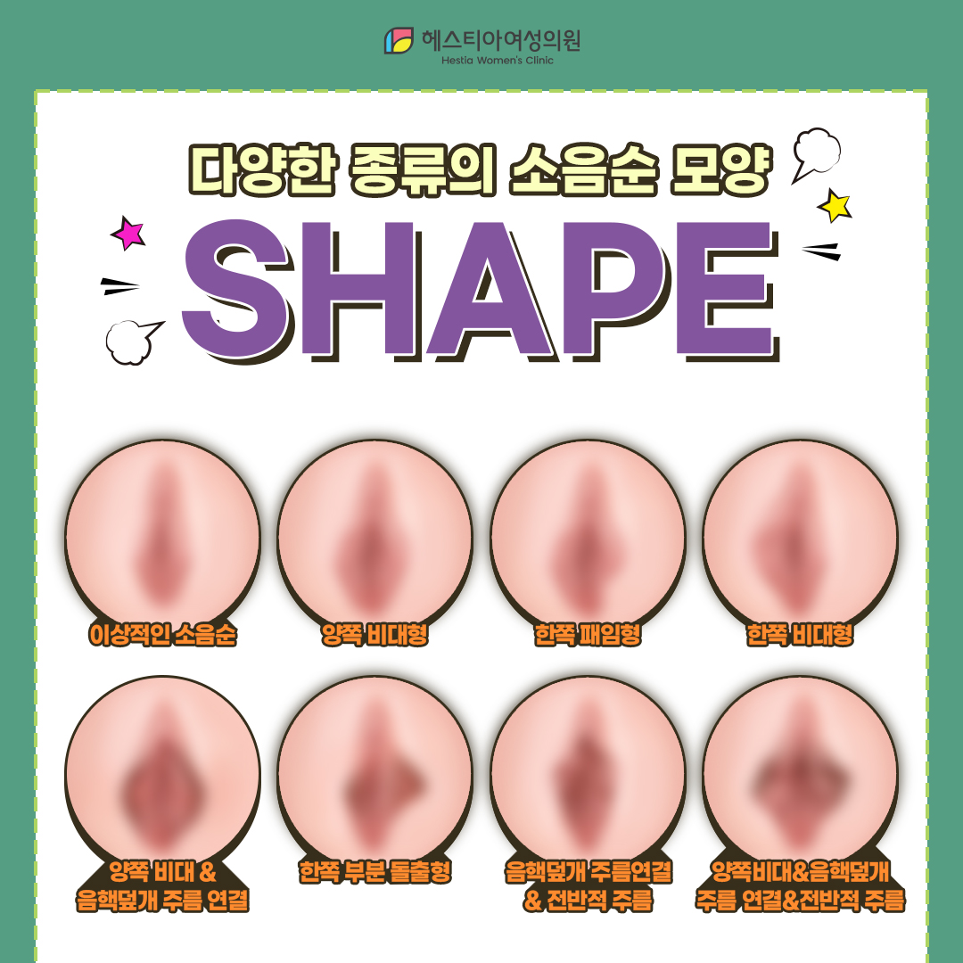 다양한 종류의 소음순 모양