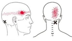 뒷골이 땡기는 증상