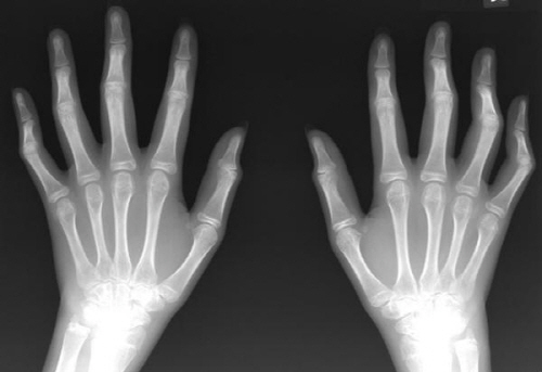 관절염으로 변형된 손가락