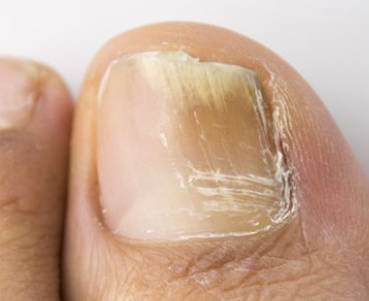 발톱무좀 증상