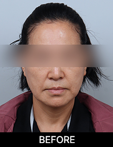 스마일리프팅가격 스마일거상