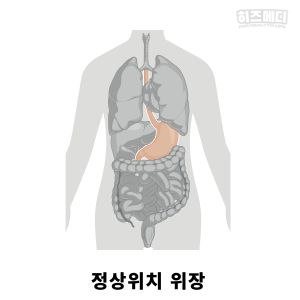 위하수증