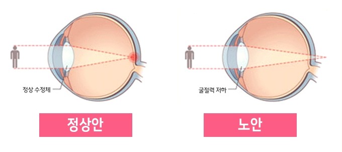 노화의 자연스러운 증상 노안, 시력저하 치료 및 예방
