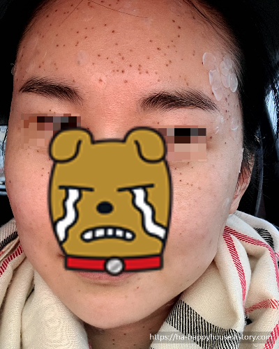 편평사마귀 시술 3일 차