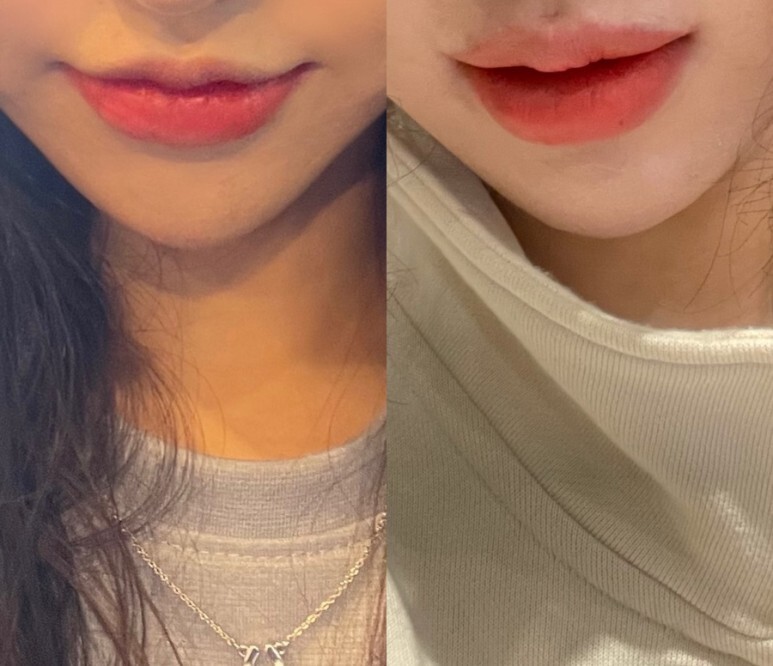 입술확대수술 후기
