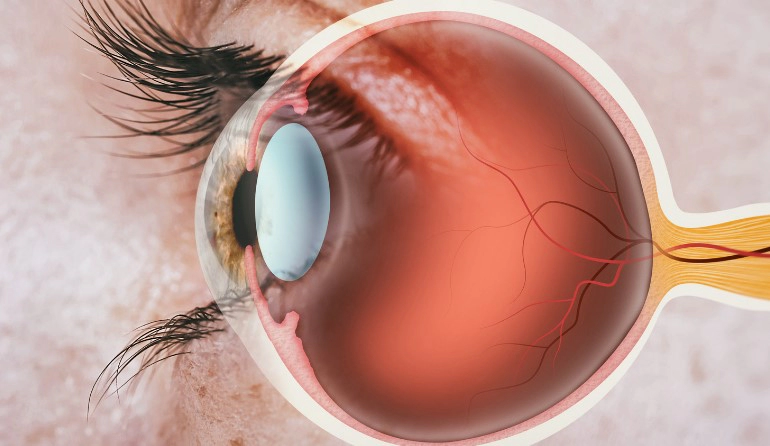 안압 낮추는법 10가지