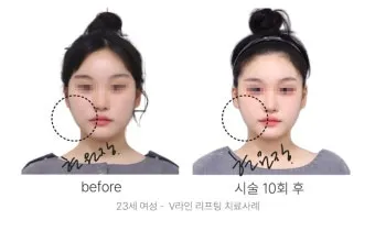 덴서티 리프팅 댄서티 가격 효과 유지기간에 관한 정보_7