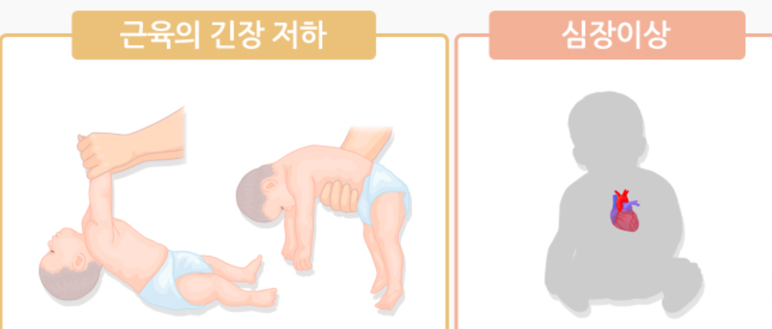 다운증후군 원인부터 증상·치료까지