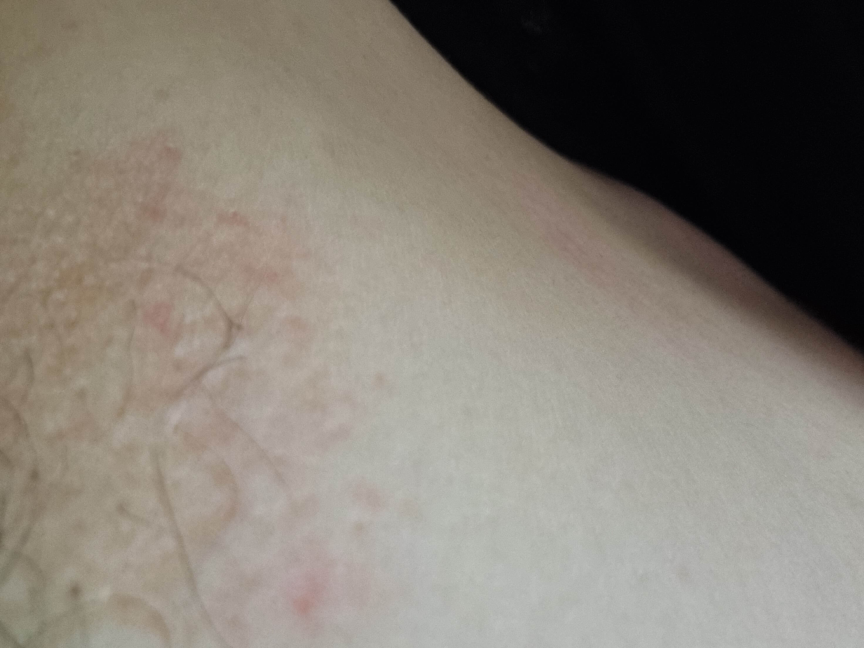 겨드랑이-간지러움-습진