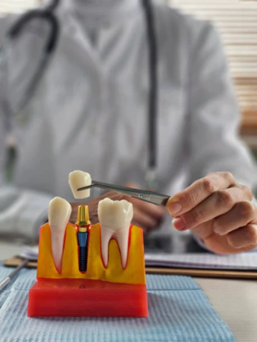 임플란트 가격 14