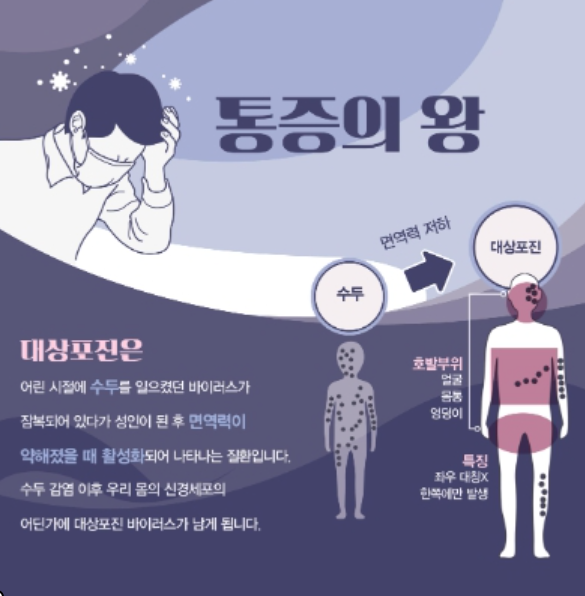 대상포진 초기 증상 후유증