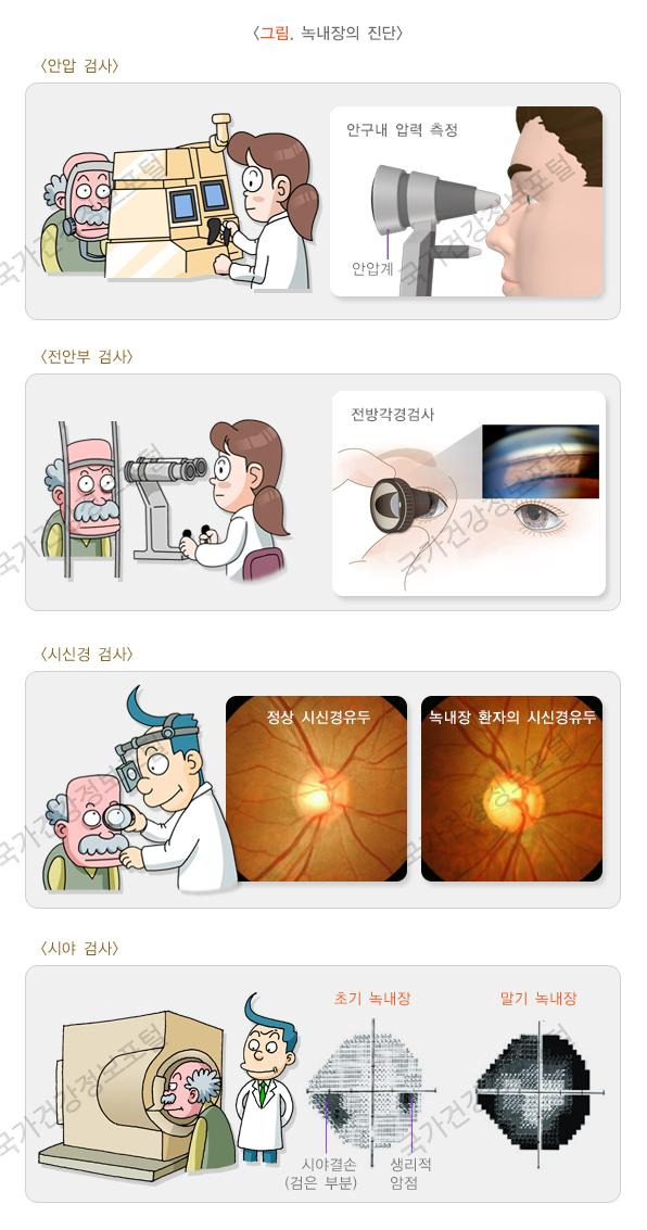 녹내장 2030대 젊은 층 급증- 증상·원인·치료