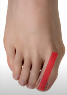 무지외반증 초간단 치료법&amp;#44; 무지외반증 교정기