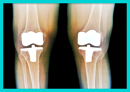 관절경수술 후 물리치료 운동 가이드