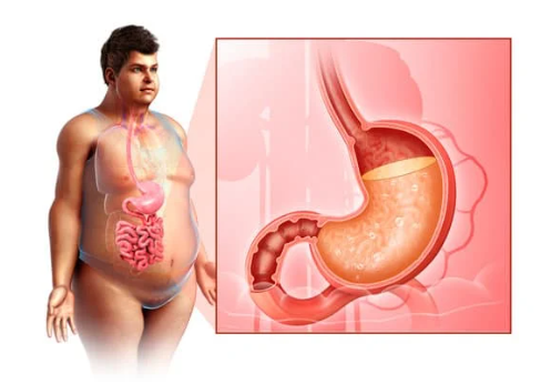 위궤양에 좋은 음식 증상 원인 치료 관리방법