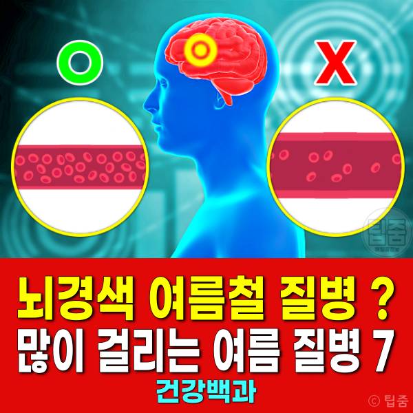 뇌경색 여름철 질병 여름질병 탈수증 열사병 외이도염 땀띠 요로감염 a형간염