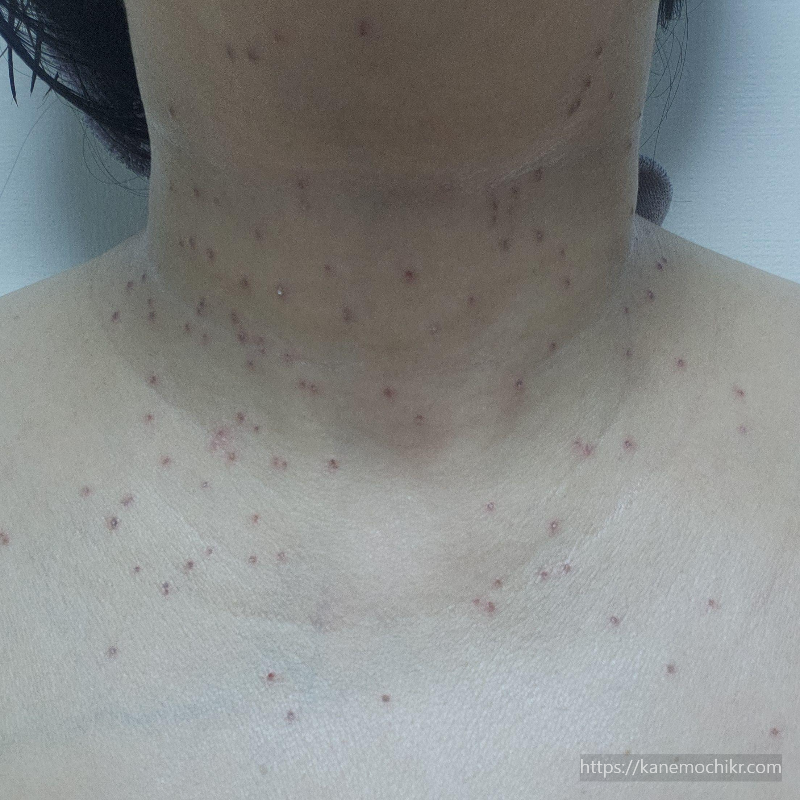 쥐젖-편평사마귀-제거-2일