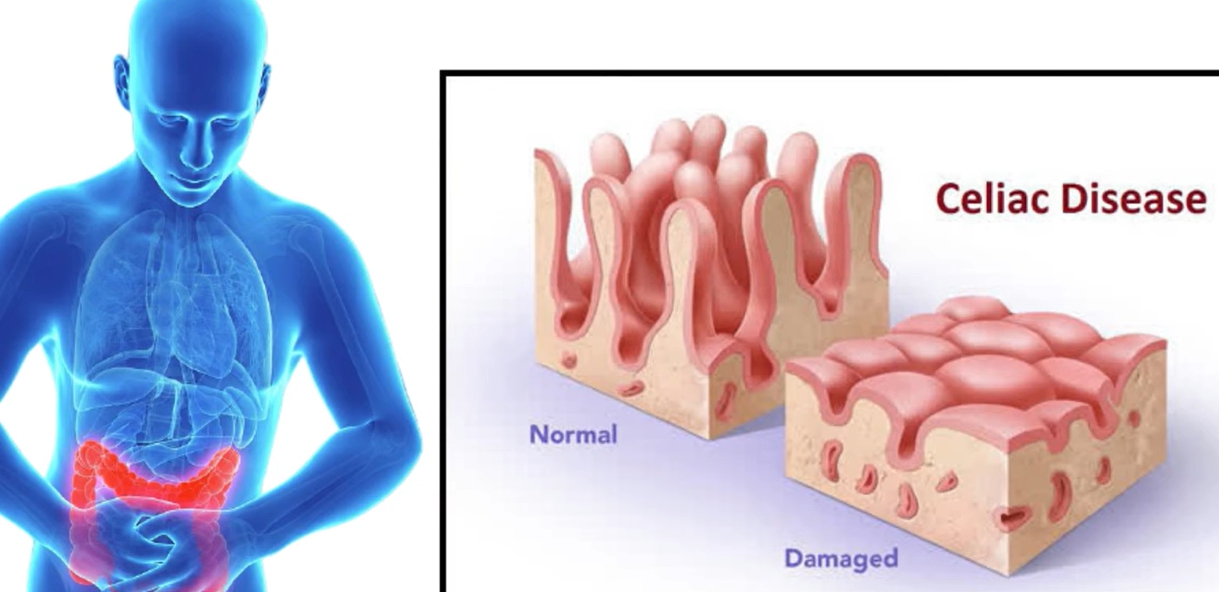 방귀 냄새가 지독해요