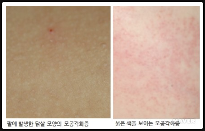 팔모공각화증