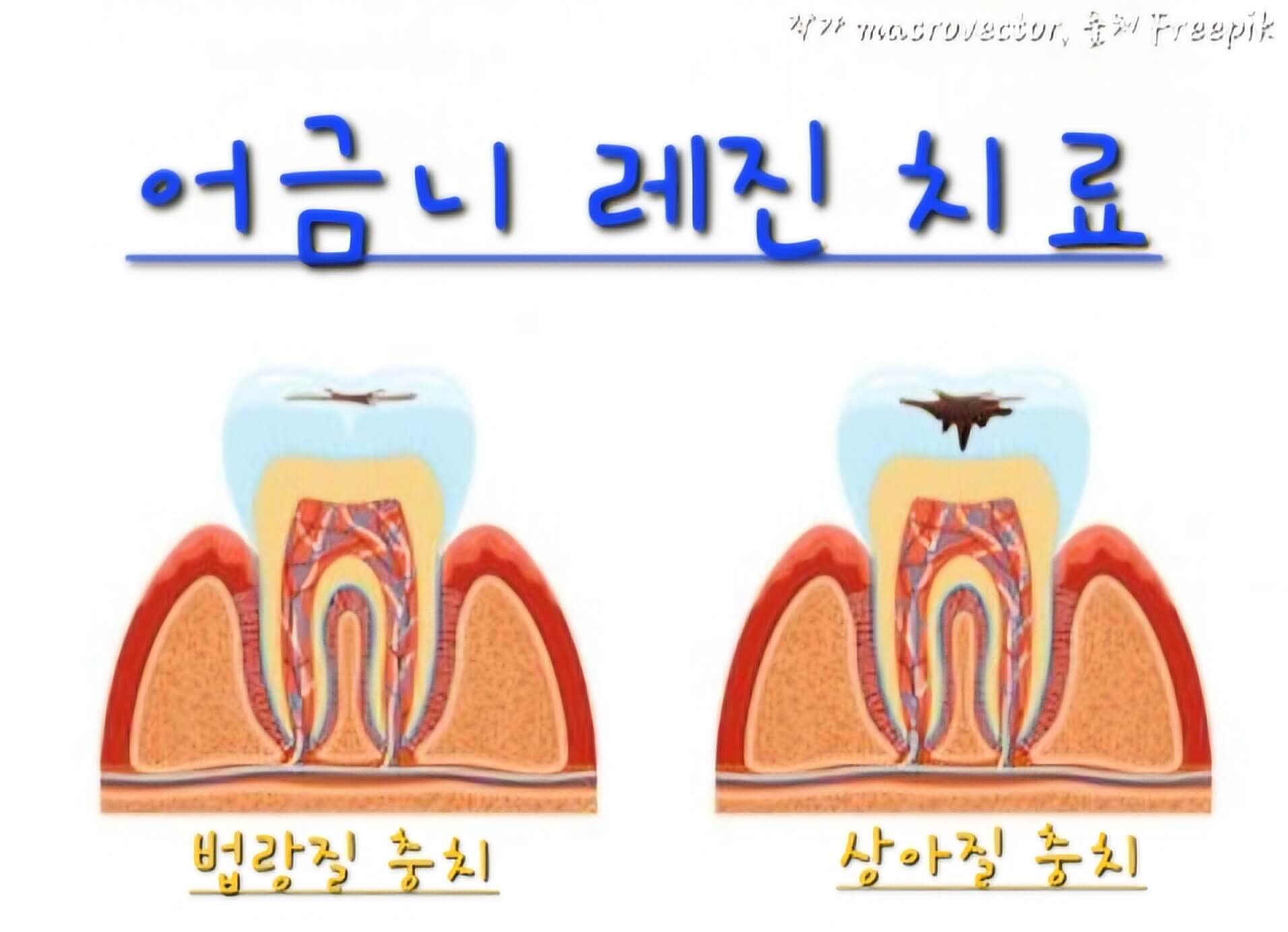 어금니 충치 사진