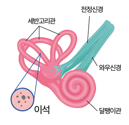 이석증 원인
