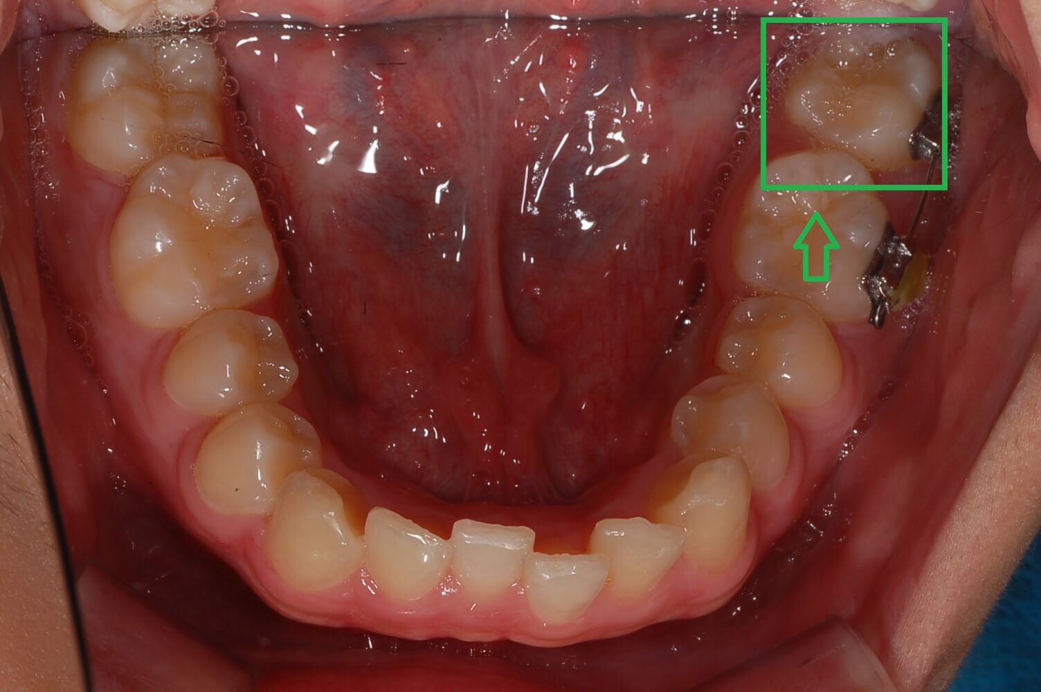 부정교합 가위교합 과개교합 치아교정 후기20
