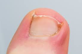 내성발톱 자가치료