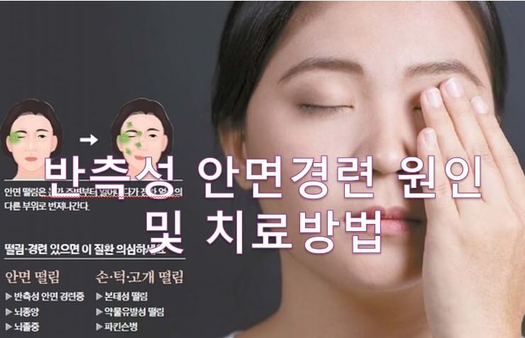 반측성 안면경련
