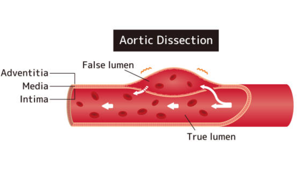대동맥 박리와 관련된 사진