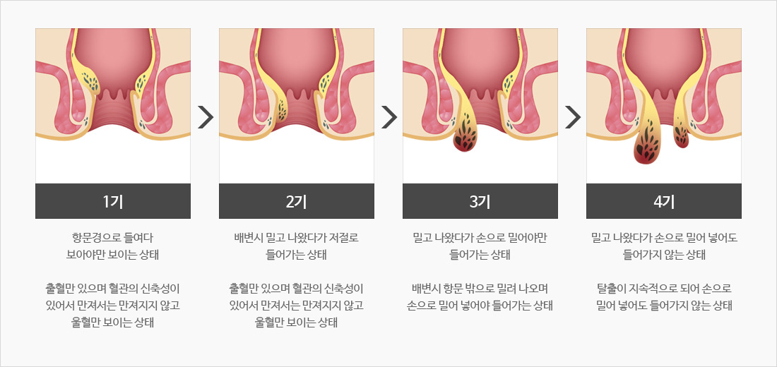 단계별 치질/ 출처 - snusurgery.co.kr