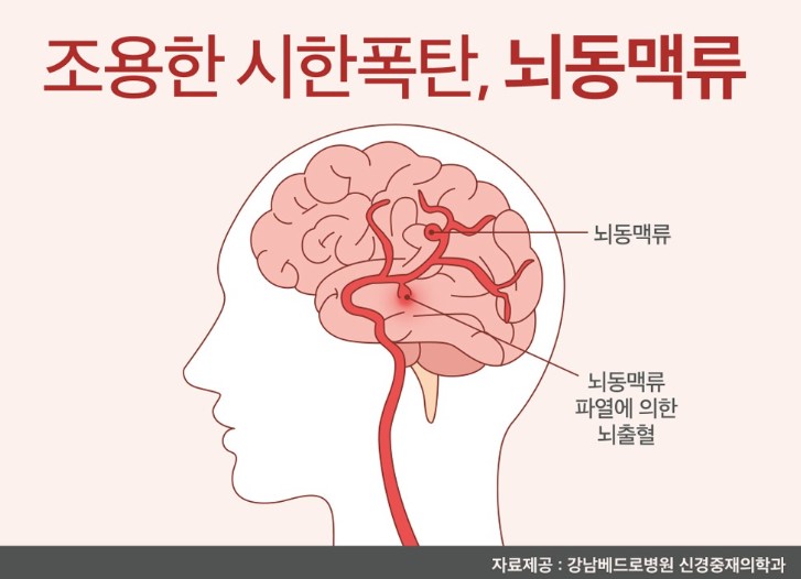 뇌동맥류