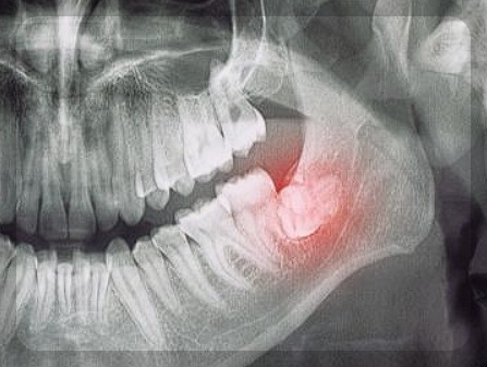 구강암-치료방법
