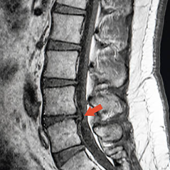 허리디스크 초기