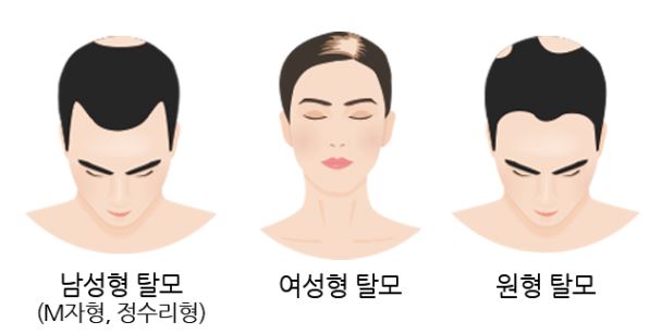 남자 여자의 탈모 사진 비교