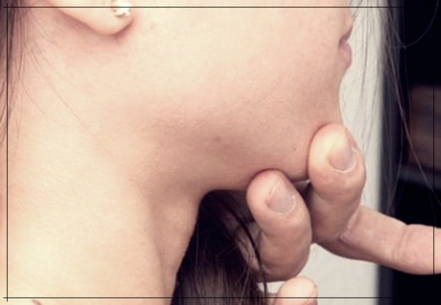 턱아래 멍울 제거 방법 5가지