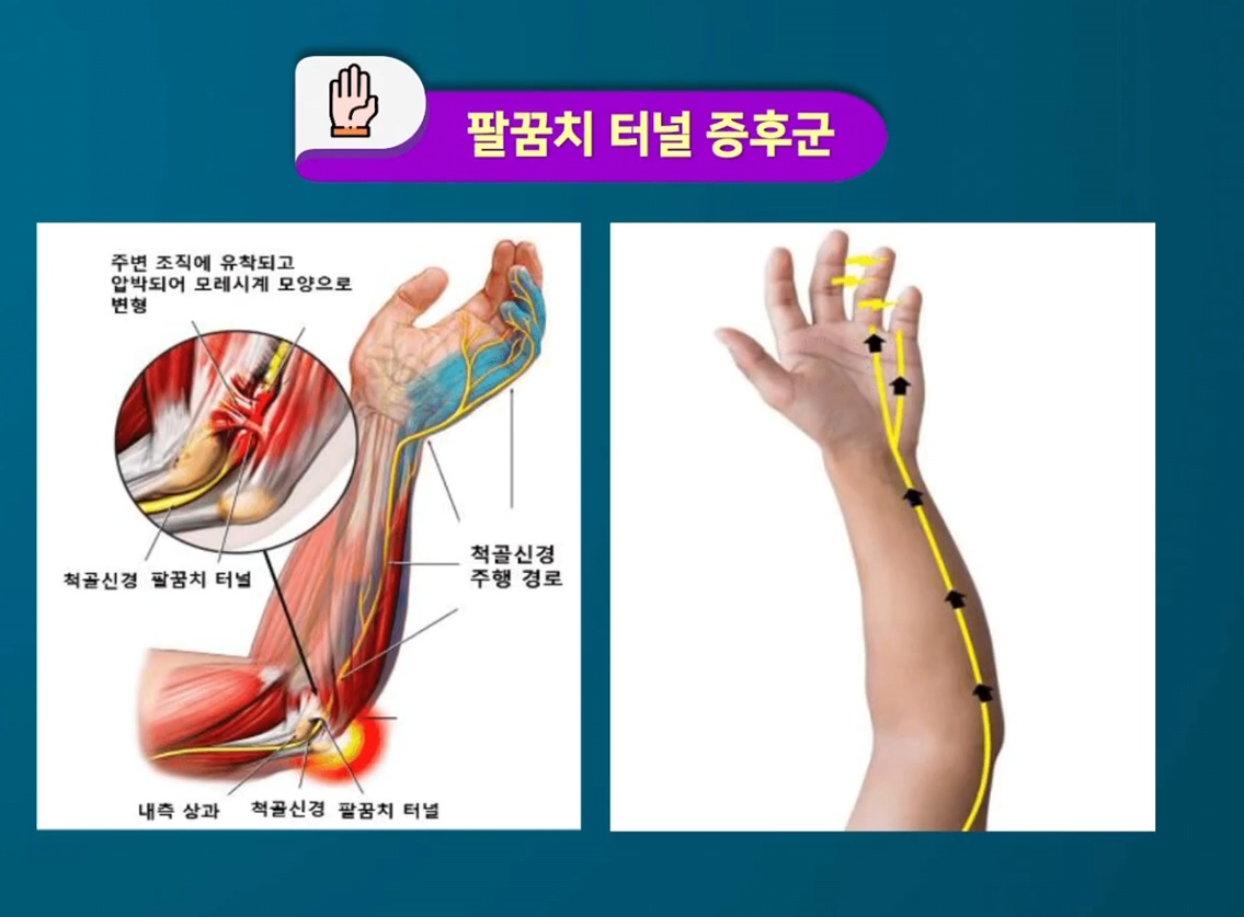 팔꿈치터널증후군