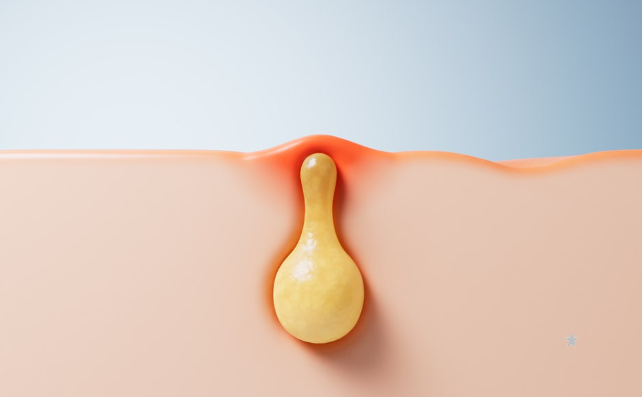 아젤리아크림 여드름에 효과 있을까? 사용 전 알아두면 좋은 핵심 포인트