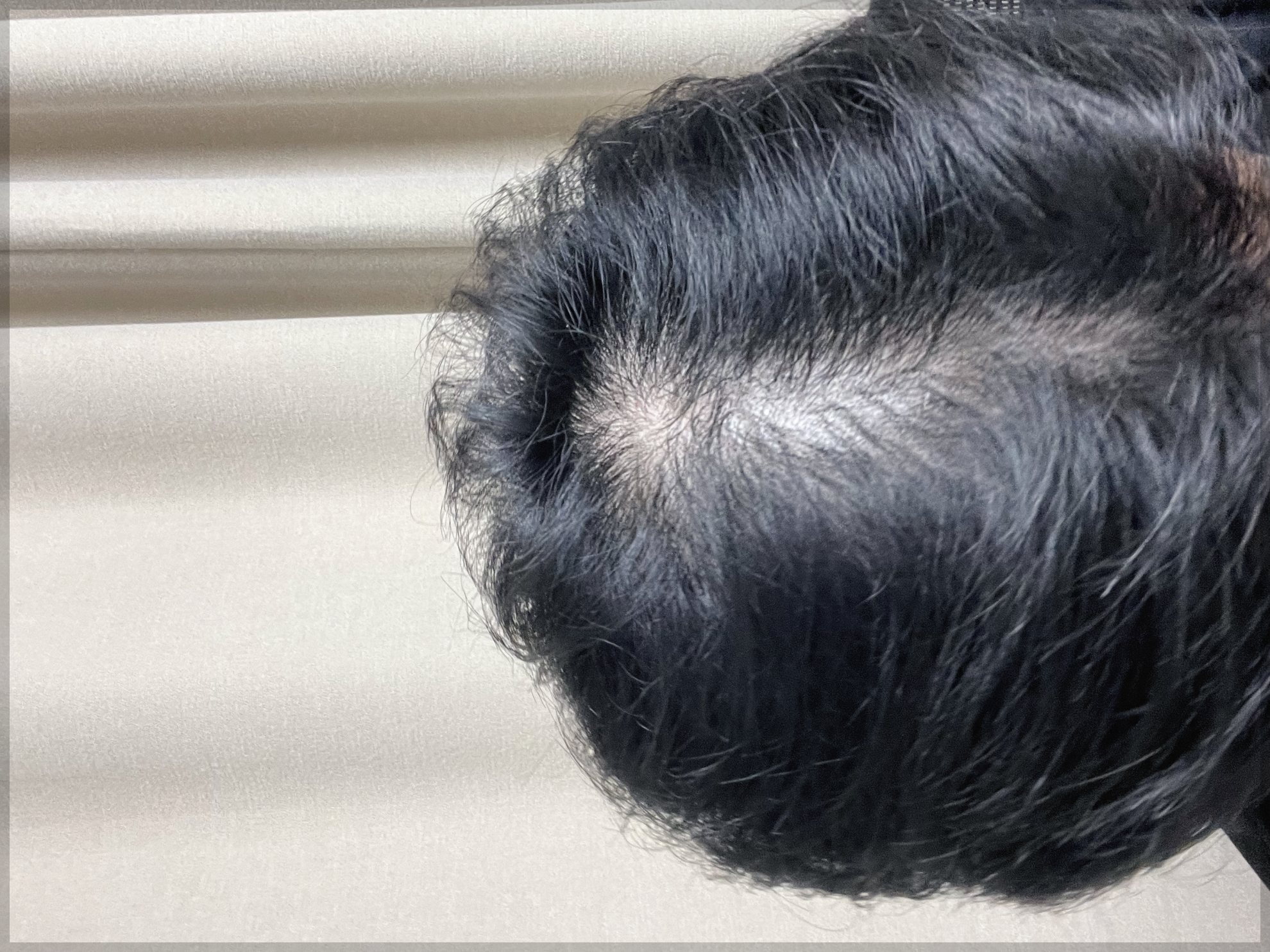 로게인폼-가격-로게인폼-부작용