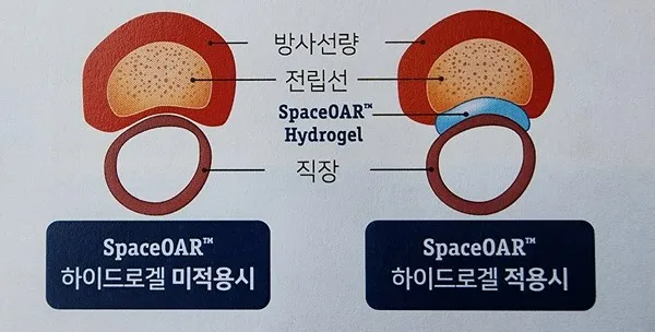 전립선암 초기증상