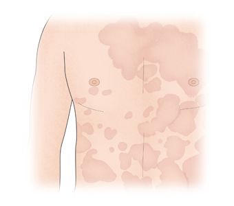 라임병 피부 발진